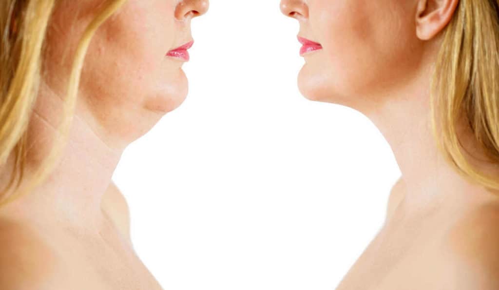 Double Chin treatment Christchurch before and after results