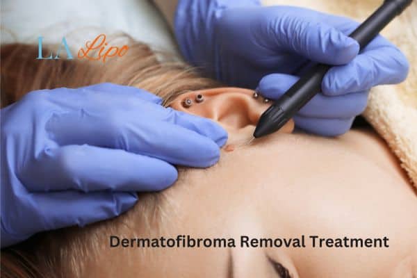 Dermatofibroma Removal Treatment Christchurch