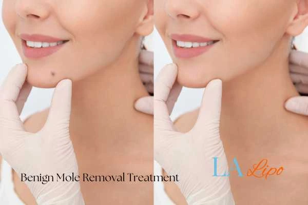 woman's before and after mole removal Christchurch results