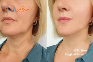hi-fu for wrinkles Christchurch before and after results