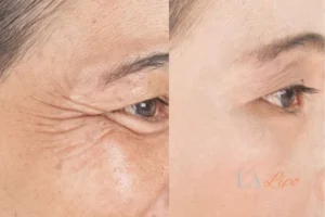 Before and after results of woman - HI-fu wrinkles reduction treatment Christchurch