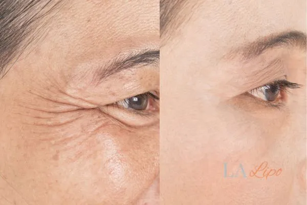 Before and after results of woman - HI-fu wrinkles reduction treatment Christchurch