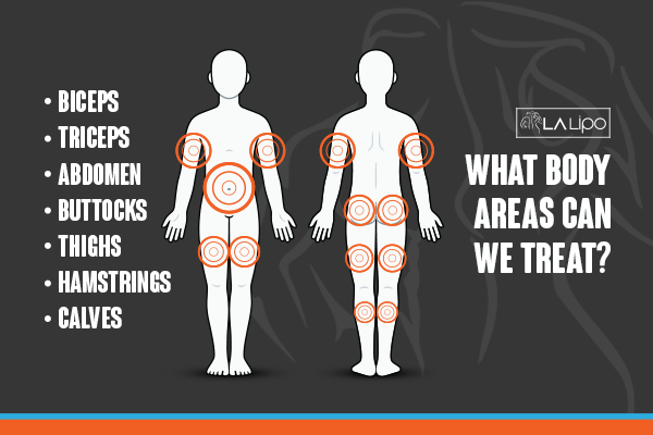 Graphic to show areas you can have LA-EMS Body Sculpting Christchurch treatment.