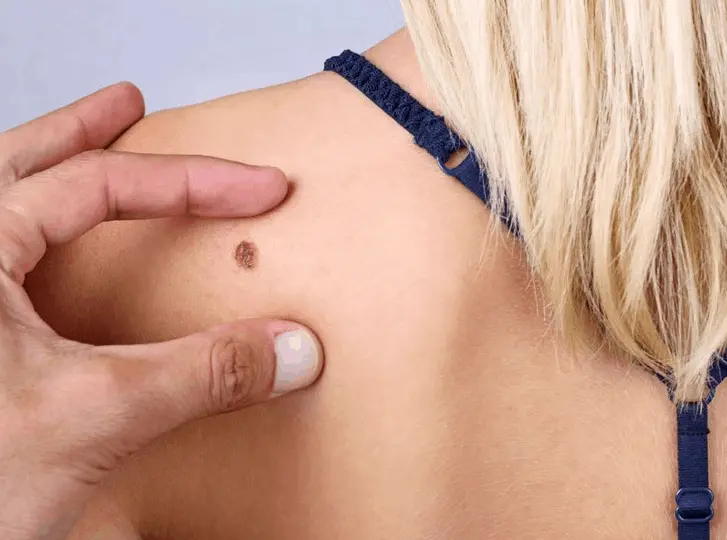woman having mole removal Christchurch consultation before treatment.