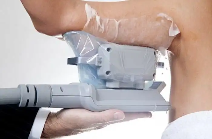 Picture of fat freezing Christchurch on the upper arms.