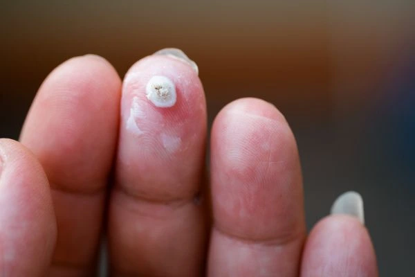 wart on person finger - cryotherapy to treat from LA LIPO Christchurch