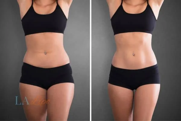 before and after results of non-surgical treatment to help a woman's body image and mental health Christchurch