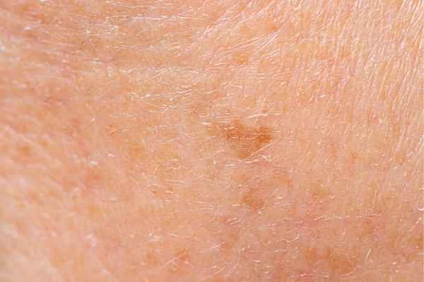 close up picture of age spots Christchurch
