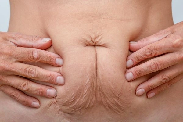 Should I Combine Diastasis Recti Treatment with Body Contouring for Better Results Christchurch?